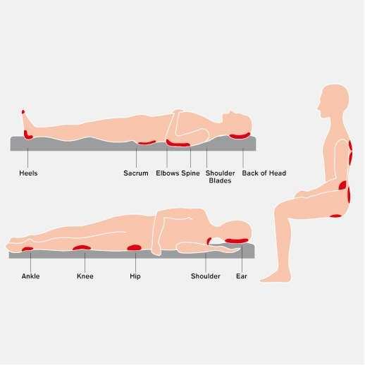Where do pressure ulcers form? Pressure ulcers are more likely to appear on parts of the body which take your weight and where the bones are close to the surface.