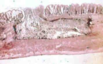 Cryptosporidium parvum: more prevalent in the immunocompromised Cyclospora cyatenensis - parasitises the small intestinal mucosa and may cause diarrhoea for several weeks Balantidium coli: a large