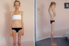 Anorexia Nervosa Bulimia Nervosa 0Persistent energy intake restriction 0Intense fear of gaining weight or of