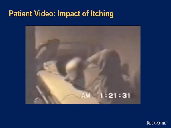 Patient Video: Impact of Itching In fact, this video of a patient sleeping at nighttime shows the impact that atopic dermatitis and its symptoms
