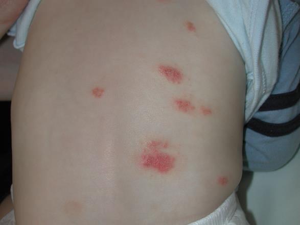 Seems to start with eczema at one site for any reason Patients not necessarily
