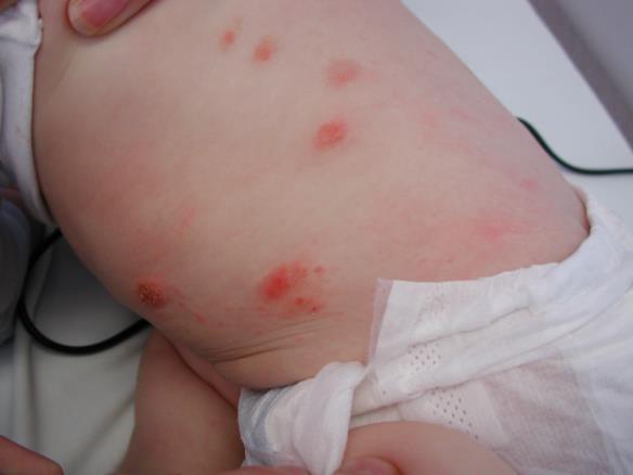 Discoid eczema Aim is to break vicious cycle Aggressive topical steroids If infected, add oral antibiotics Wet dressings Sunlight/UVB very useful Lower threshold for systemic immunosuppression if