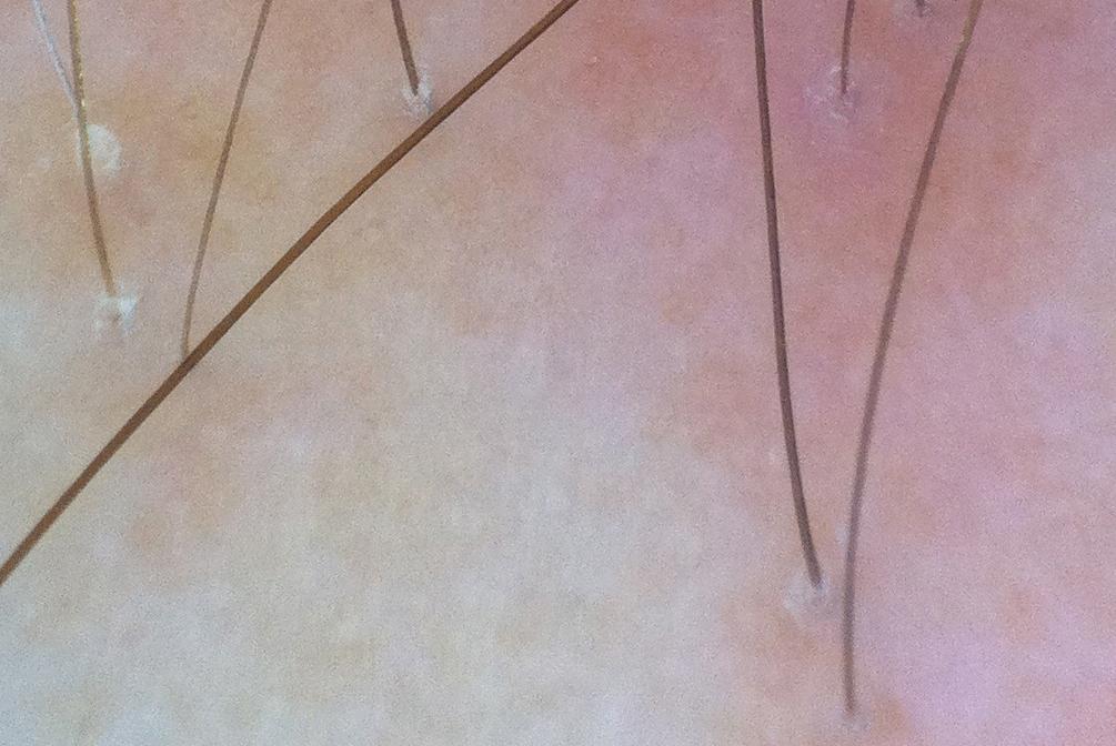 Absence of vellus hair in the hairline: a videodermatoscopic