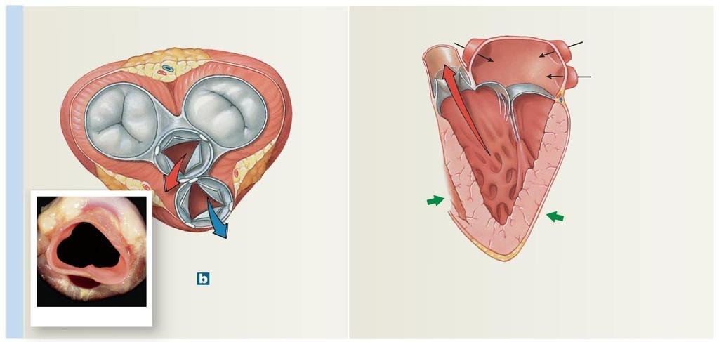 Contracting ventricles Figure 12-6b The Valves of the Heart.