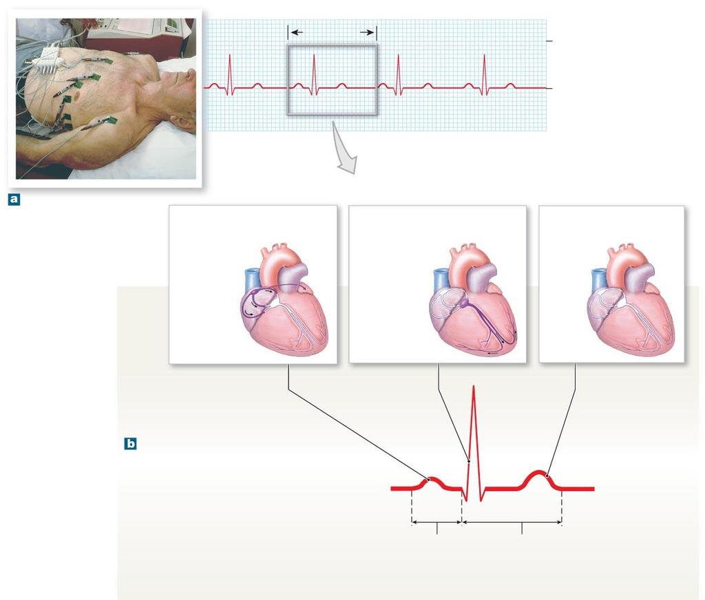 Figure 12-10 An Electrocardiogram. 800 msec 0 +1Millivolts ECG rhythm strip Electrode placement for recording a standard ECG. The small P wave accompanies the depolarization of the atria.
