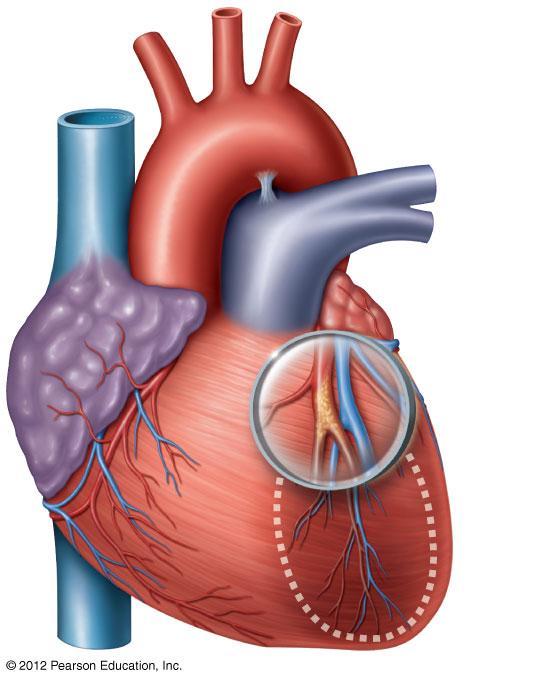 Figure 20-10 Heart Disease and Heart Attacks