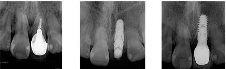 reported that the buccal bone of maxillary anterior area become clearly visible in the controlled group and grafting bone right after extraction is effective to reduce the buccal bone loss more or