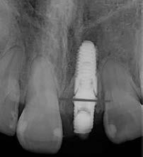 20 Cho HJ, et al: Peri-implant gingival tissue changes following immediate implant placement mesial and distal aspect of the implant were determined (Fig. 3).