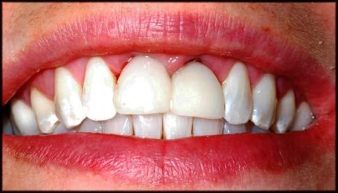 After taking an immediate implant level impression, the case was sent to a Biodenta partner laboratory.