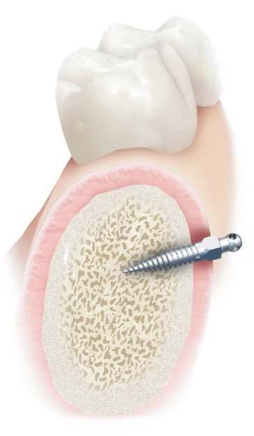 Implant Length Selection Implant length is determined by bone and soft tissue thickness The complete 1.