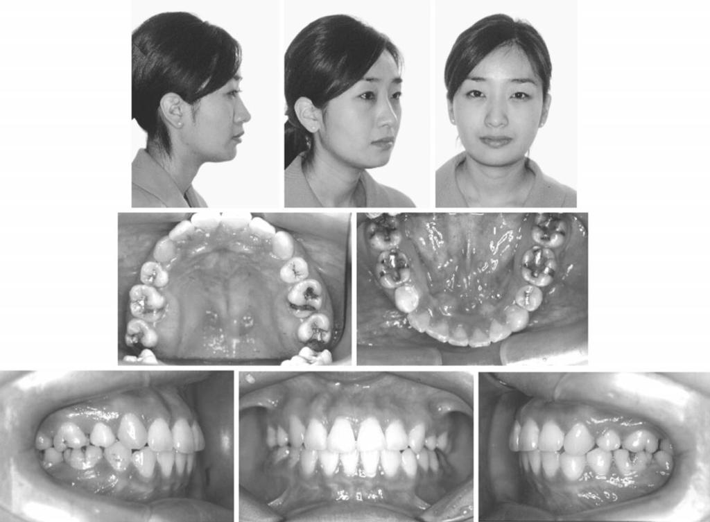 138 HONG, HEO, HA FIGURE 13. Posttreatment facial and intraoral photographs. Case 2 Case 2 demonstrates a 22-year-old Korean female who complained of lip protrusion and crowding.
