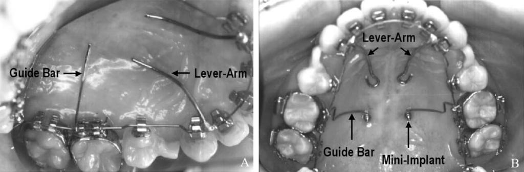 Intraoral photographs before (A) and after (B) establishing a lever-arm and mini-implant system.