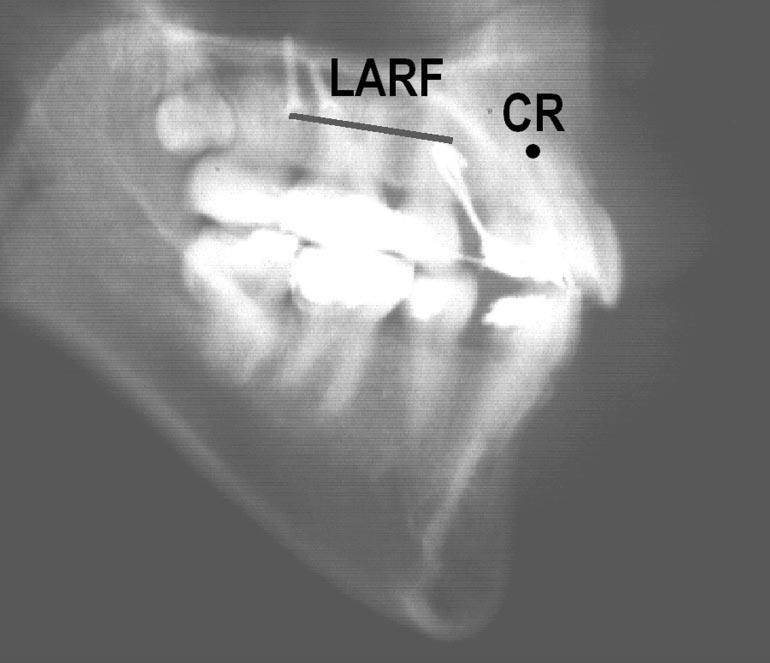 The line of action of the retraction force (LARF) passes through the center of resistance of the 6 anterior teeth (CR) and is parallel to the occlusal plane.