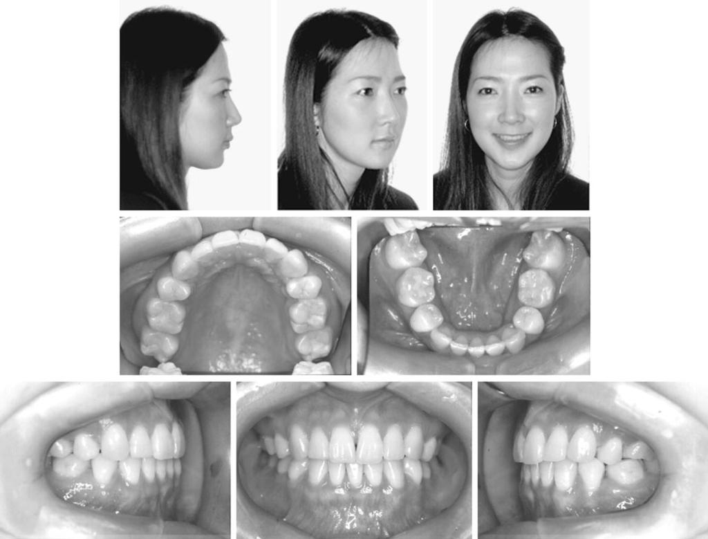 134 HONG, HEO, HA FIGURE 8. Posttreatment facial and intraoral photographs. the palatal soft tissue and the available bone quantity at the desired implantation site.