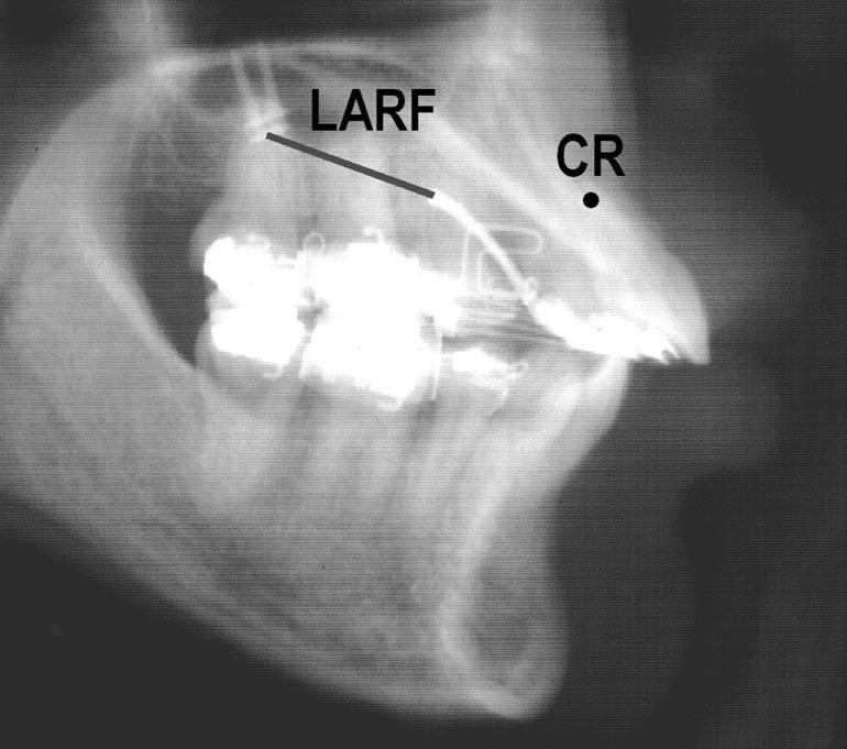 The line of action of the retraction force (LARF) passes inferior to the center of resistance of the 6 anterior teeth (CR).