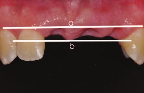 C L I N I C A L Figure 2: Frontal view of extended edentulous space. (a) gingival margin position, (b) height of exisiting papillae. Figure 3: Occlusal view of extended edentulous space.