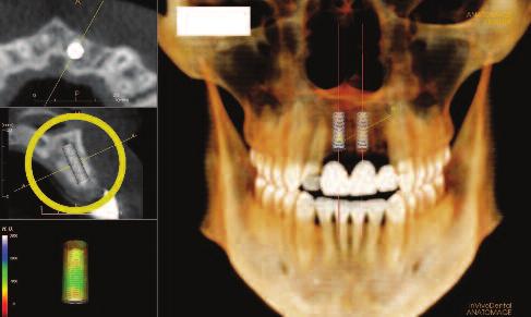 The horizontal distance between implants and teeth should approximate 1.5mm.