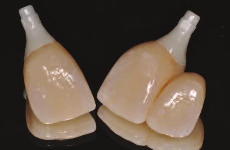 Utilizing CAD/CAM technology, prefabricated ZrO2 abutments (Ivoclar, Buffalo, NY) were utilized, followed by fabrication of ZrO2 copings (CAD/CAM by Straumann ) which were then veneered with