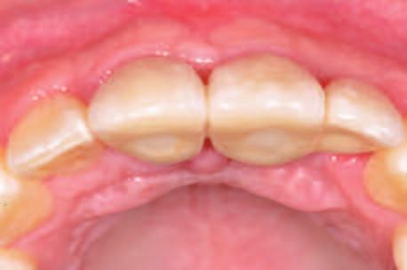 Clinical and radiographic evaluation of the papilla level adjacent to single-tooth dental implants. A retrospective study in the maxillary anterior region. J Periodontol.