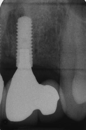 Degidi M, Nardi D, Piattelli A. Peri-implant tissue and radiographic bone levels in the immediately restored singletooth implant: a retrospective analysis. J Periodontol.