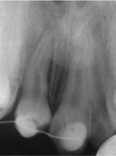premolars Fig 13: One week