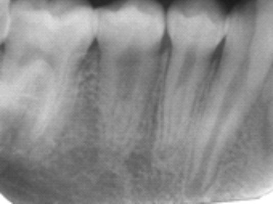 right premolar tooth in the