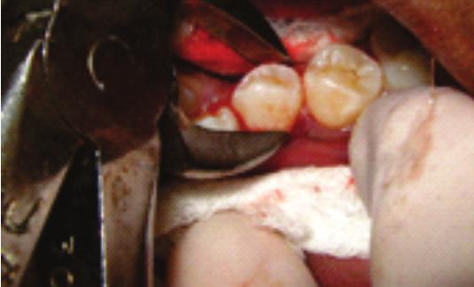 of both central incisors Fig