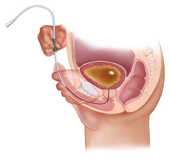Using the gripper to hold the catheter firmly, gently pass the tip of the catheter into your urethra until the gripper nears the meatus.