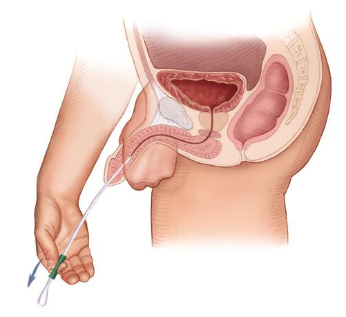 YOUR HYDROSIL CATHETER much as you can before using an intermittent catheter. Step 5b (for HydroSil Male) Wash your hands again and take the catheter out of the pouch holding the funnel end.
