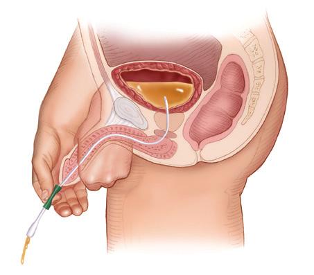 Hold your penis up towards your stomach as this will make it easier to slide the catheter into your bladder. Avoid squeezing the penis as this can block your urethra.