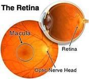 Diabetic Retinopathy What is Diabetic Retinopathy Diabetic retinopathy is one of the leading causes of blindness world-wide.