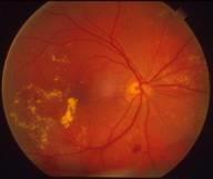 This is proliferative diabetic retinopathy and is the fourth and most advanced stage of the disease. Macular Edema.