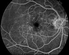 It can occur at any stage of diabetic retinopathy, although it is more likely to occur as the disease progresses. Macular ischemia.