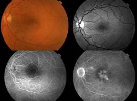 If new blood vessels grow on the surface of the retina, they can bleed into the eye and reduce vision What are the symptoms of proliferative diabetic retinopathy if bleeding occurs?