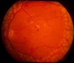 Treatment How is diabetic retinopathy treated? During the first three stages of diabetic retinopathy, no treatment is needed, unless you have macular edema.