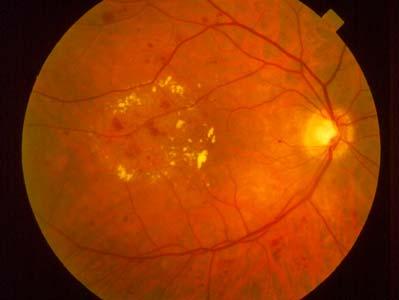Nonproliferative diabetic retinopathy (NPDR) also called background diabetic retinopathy earliest stage of diabetic retinopathy Damaged blood vessels leak fluid (from blood plasma) and small amounts