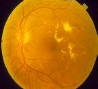 Types of Diabetic Retinopathy There are two main categories of diabetic retinopathy: Non proliferative diabetic retinopathy (when the blood vessels leak and then close), and proliferative diabetic