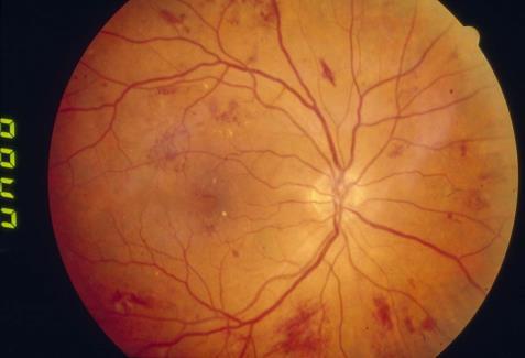 companies: Carl Zeiss Meditec Arctic DX Macula Risk Advanced Ocular Care Genentech USA USMA Lampa Advisory