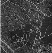 OCT angiography Zeiss AngioPlex
