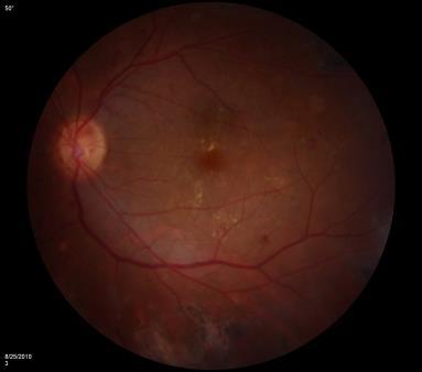 Vitreous Hemorrhage and Traction Retinal Detachments