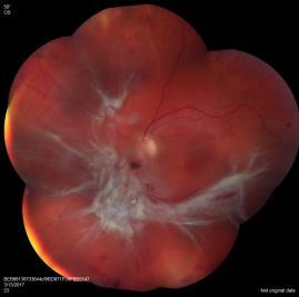 panretinal photocoagulation (PRP) with a primary endpoint