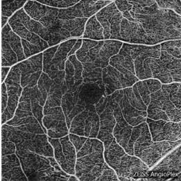 for patients with a chronic diabetic eye disease?