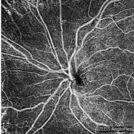 Type I Diabetes with Proliferative Retinopathy PRP laser treatment in 1990 - OCTA Although clinical trials have defined the