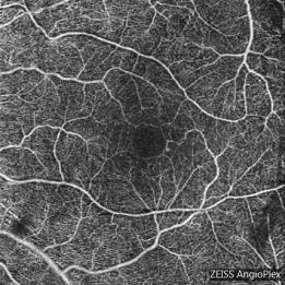 .intravitreal agents like Avastin/Lucentis, Eylea and Steroids have rapidly become adjuncts to laser treatment and prior to