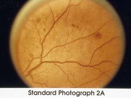 more severe retinopathy - Classification of : Very Severe Non