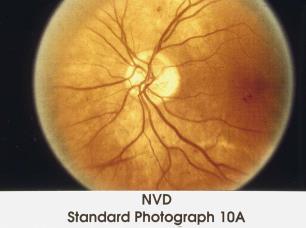 NPDR 52 71 - Classification of : Proliferative Neovascularization of the disc (NVD) < Standard photo 10A (<0.25 0.