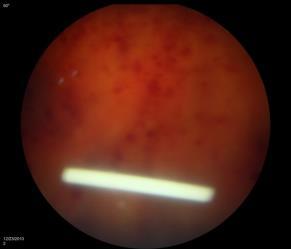 treated with intravitreal agents