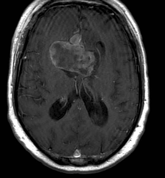 Brain Tumors Brain Tumor