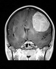 Brain Tumors Skull is a fixed space