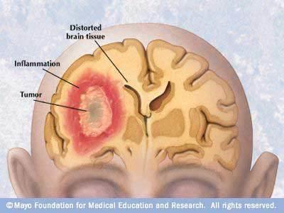 Brain Tumors Inflammation/Edema